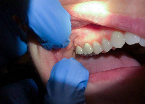 Best Emergency Dental Care for Broken or Chipped Teeth in Amite City, LA